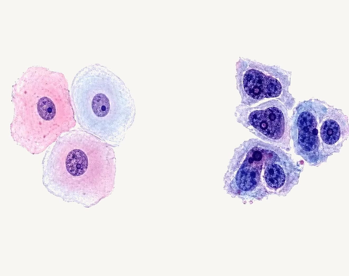 Original cellular comparison image: normal-appearing cells with a smooth waveform on the left, and atypical cells with a variable waveform on the right.