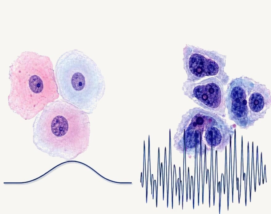 Original cellular comparison image: normal-appearing cells with a smooth waveform on the left, and atypical cells with a variable waveform on the right.